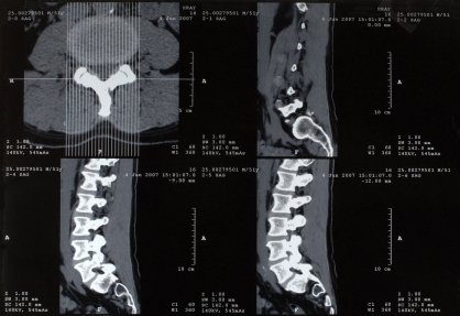 If you've suffered a spinal cord injury caused by a medical error, Mickey Fine can help you recover the compensation you deserve. (661) 333-3333 Bakersfield