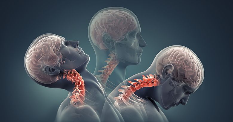 Whiplash Injury Diagram