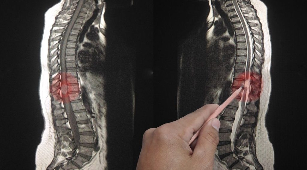 Compensation for a Spinal Cord Injury