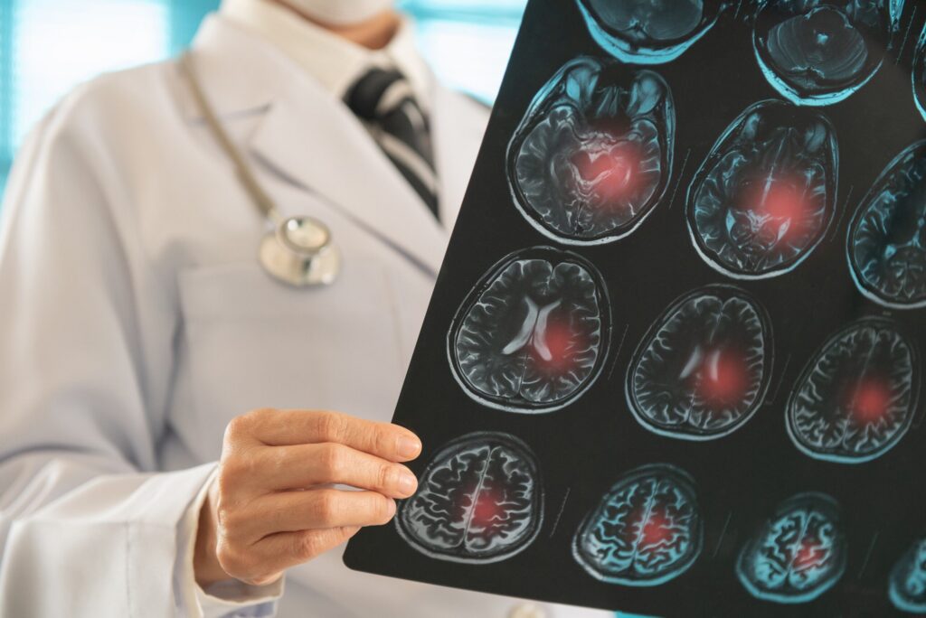 Doctor reviewing brain scan results related to traumatic brain injury care in Bakersfield