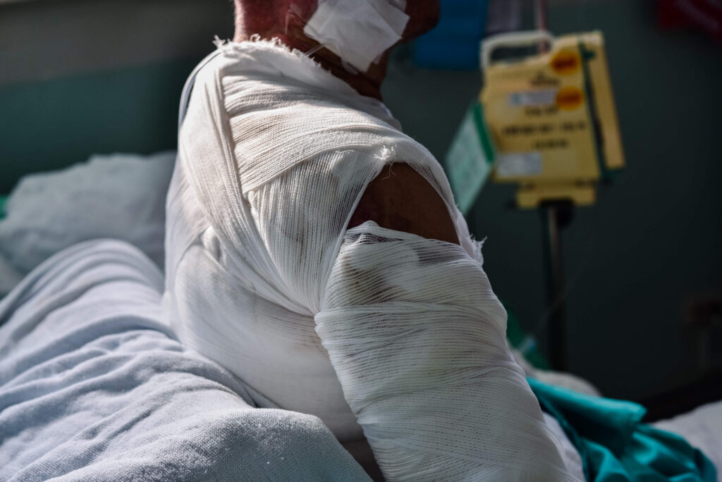A patient in a hospital bed with heavily bandaged burn injuries, representing severe injury cases managed by Bakersfield Burn Injury Lawyers.